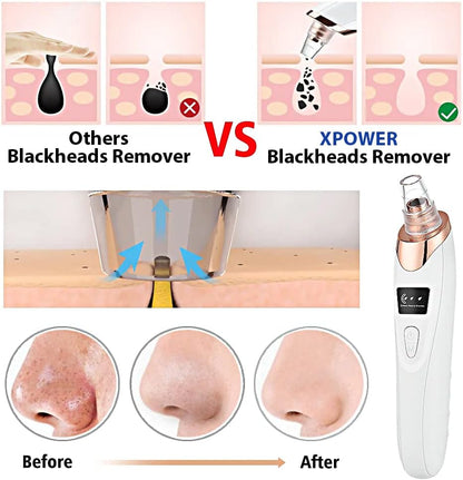 XPOWER Handheld Blackhead Remover Vacuum with 5pcs