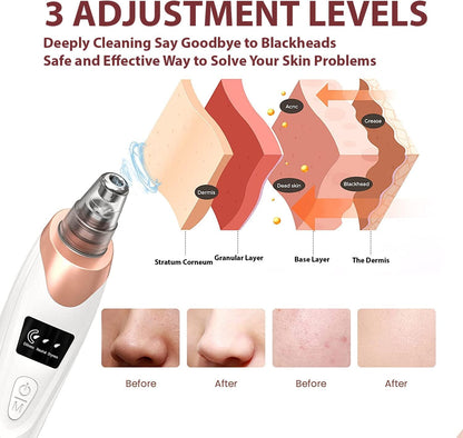 XPOWER Handheld Blackhead Remover Vacuum with 5pcs